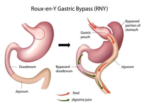 gastric bypass surgery roux en y