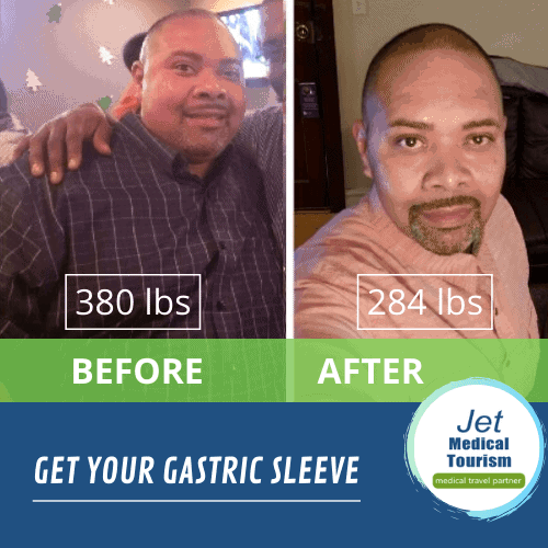 Gastric Sleeve Before and After Pictures Male