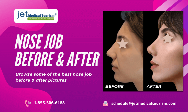Nose Job Before and After