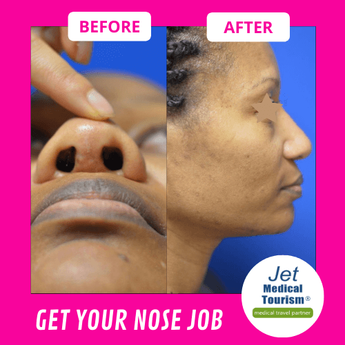 African American rhinoplasty before and after