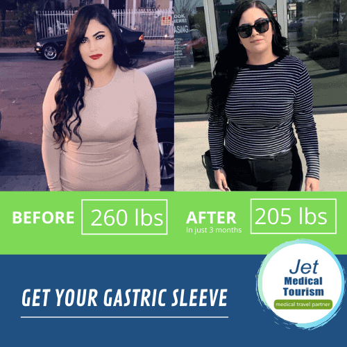 Gastric sleeve before after 3 months