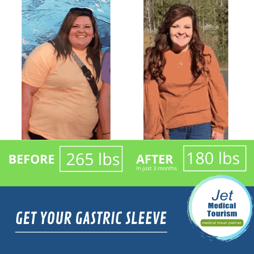 Gastric sleeve before and after 3 months