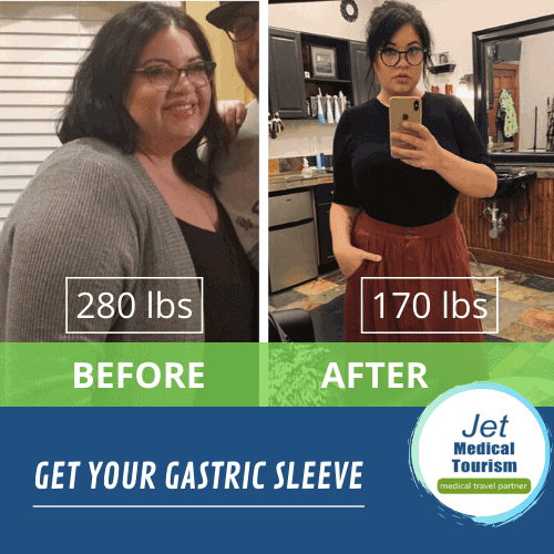 Gastric sleeve before and after 2021