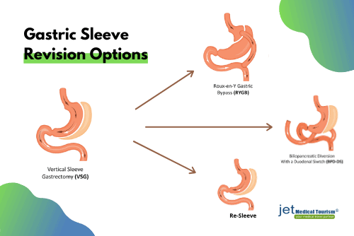 Gastric Sleeve Revision Options