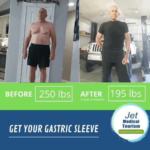 Male Gastric Sleeve Surgery Before and after Picture