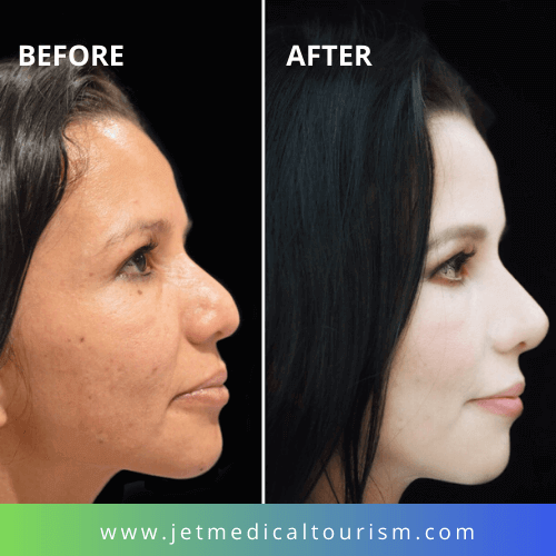 Is it Safe to Get a Nose Job in Mexico? Jet Medical Tourism® in Mexico