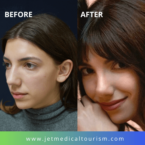 Before and After Rhinoplasty, Nose Job in Mexico