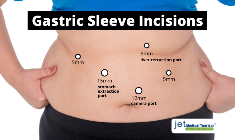 Gastric Sleeve Incisions illustrations