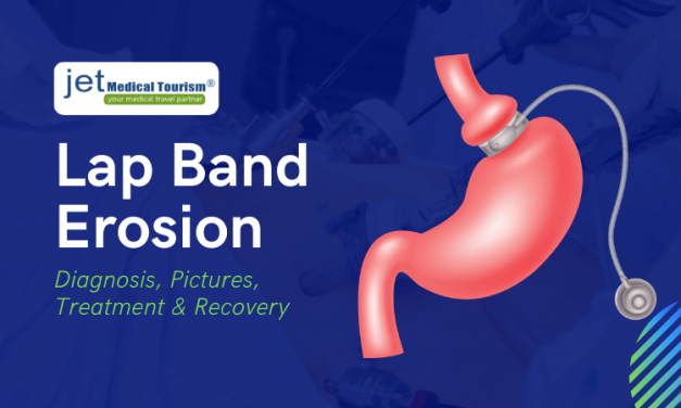 Lap Band Erosion: Diagnosis, Pictures, Treatment & Recovery