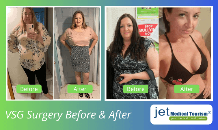 Vertical sleeve gastrectomy before and after pictures