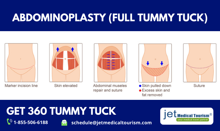 What is 360 Tummy Tuck