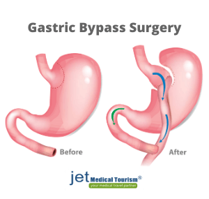 gastric bypass surgery