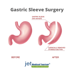 Morbid obesity BMI chart: Am I morbidly obese? Jet Medical Tourism®