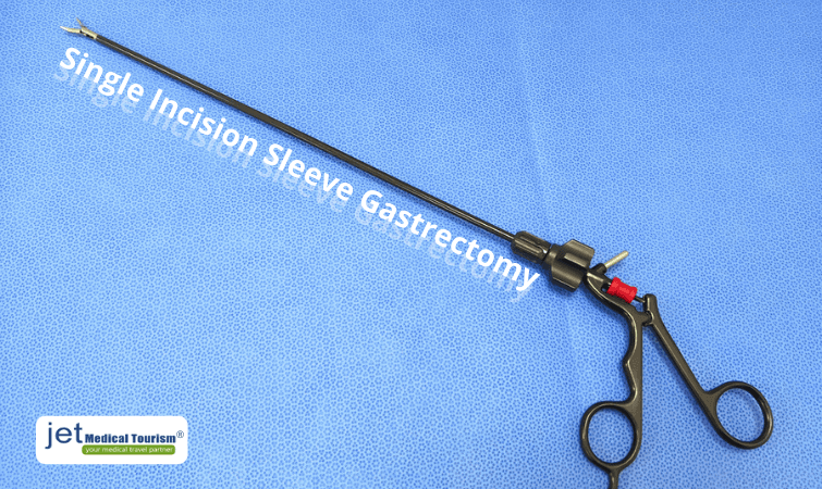 single incision sleeve gastrectomy
