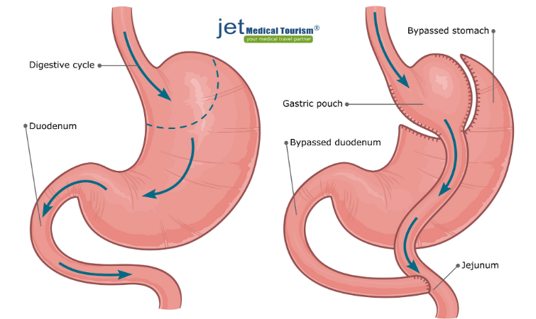 Gastric Bypass Surgery Duration