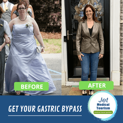 gastric bypass before and after pic