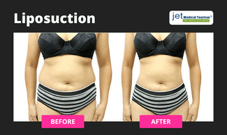 Liposuction Before and After 