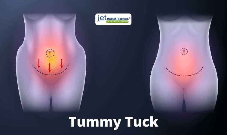 What is Tummy Tuck