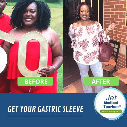Gastric Sleeve Before and After Pictures