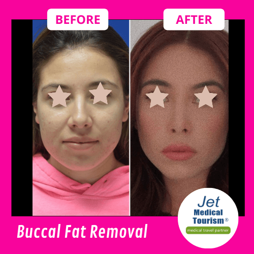 Buccal Fat Removal Before and After