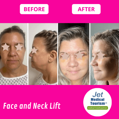 Face and Neck Lift Before and After
