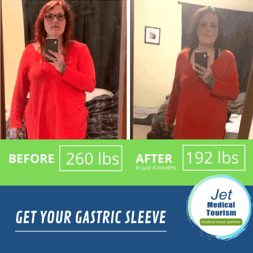 Gastric Sleeve before and after 68lbs weight loss