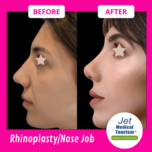 Rhinoplasty/Nose Job Before and After