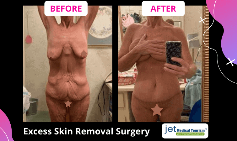 Excess skin removal before and after pics