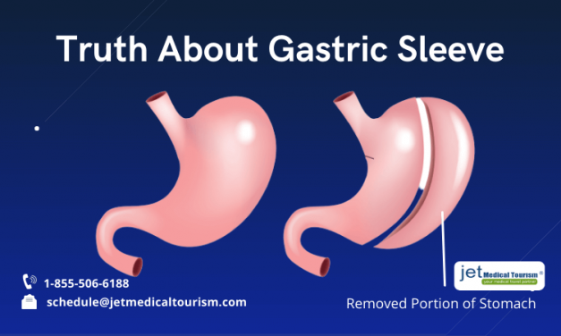 Truth About Gastric Sleeve Revealed
