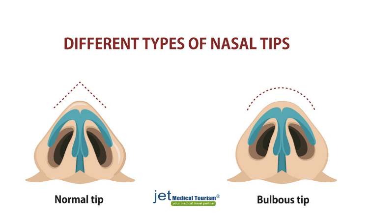 Bulbous Nose Job Rhinoplasty - Jet Medical Tourism®