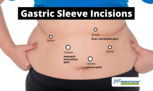 Gastric Sleeve Scars - Minimize Scars to Stomach - Jet Medical Tourism ...