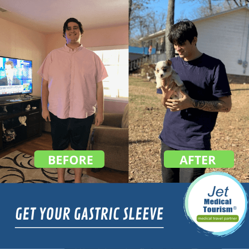 Male Gastric Sleeve Before and after Picture