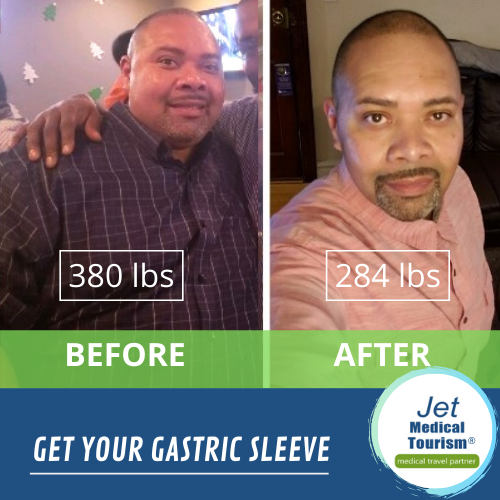 gastric sleeve before and after male