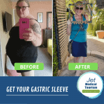 Gastric Sleeve Before and After Pictures: Best VSG Photos (2022)