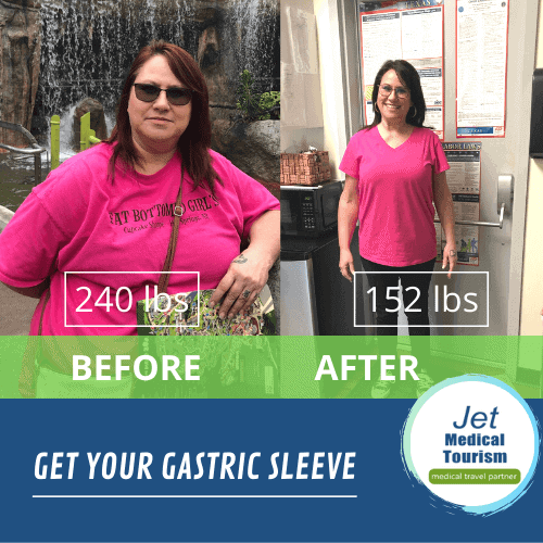 gastric sleeve before and after pics