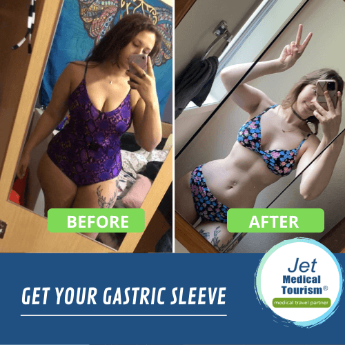 Gastric sleeve surgery before and after female