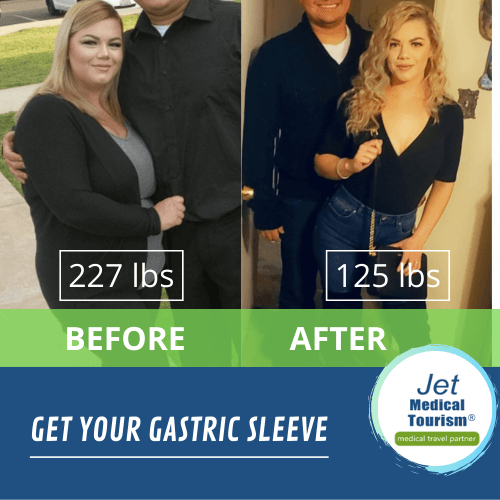 Roxxanne’s Gastric Sleeve Before and After Picture