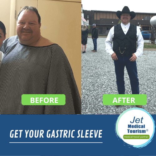 Gastric sleeve before and after pictures male