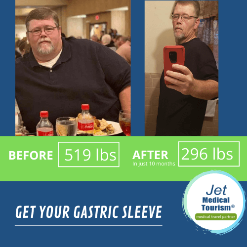 best gastric sleeve before and after pictures men