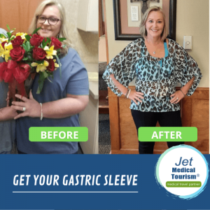 Gastric Sleeve Surgery Before and After