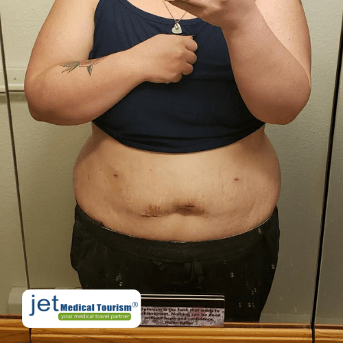 gastric sleeve surgery scars