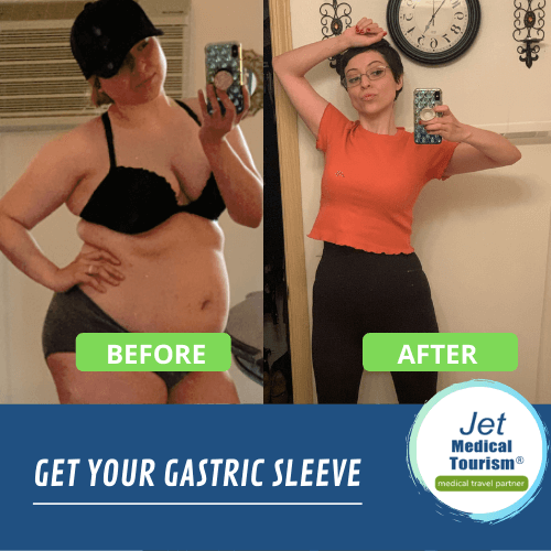 sleeve gastrectomy before and after