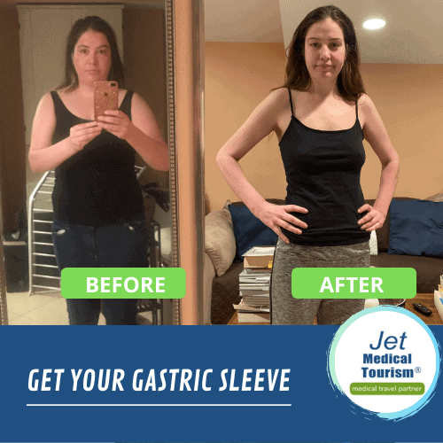 Gastric sleeve before and after women