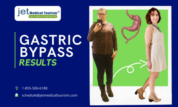 Gastric Bypass Results