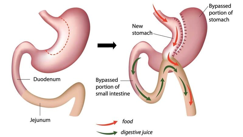 Mini Gastric Bypass Surgery in Mexico