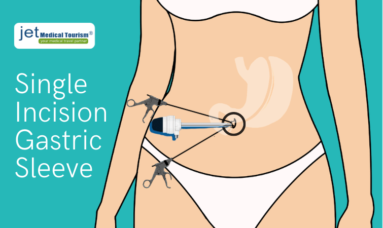Single Incision Gastric Sleeve (SILS) in Mexico