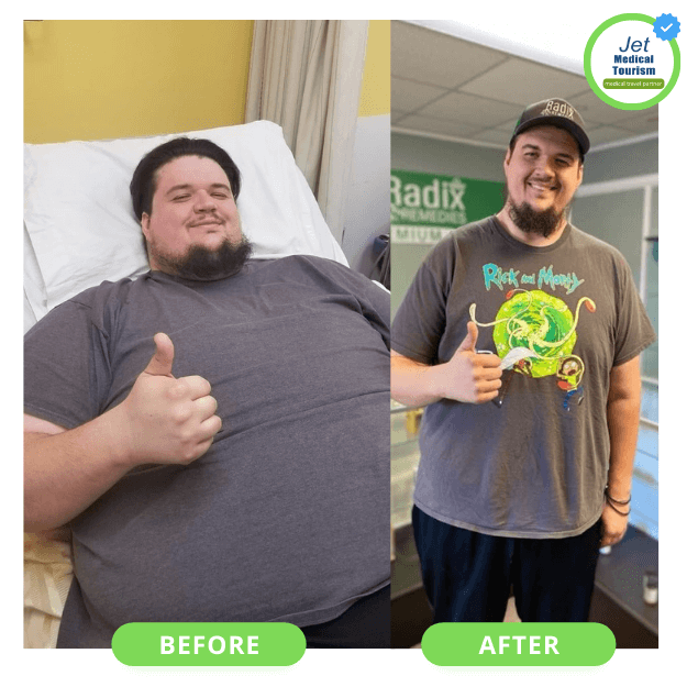 Bariatric surgery before and after transformation