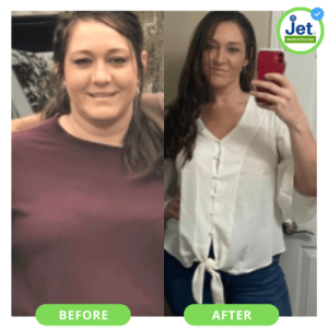 Gastric Sleeve Before And After Pictures: Best Vsg Photos (2023)