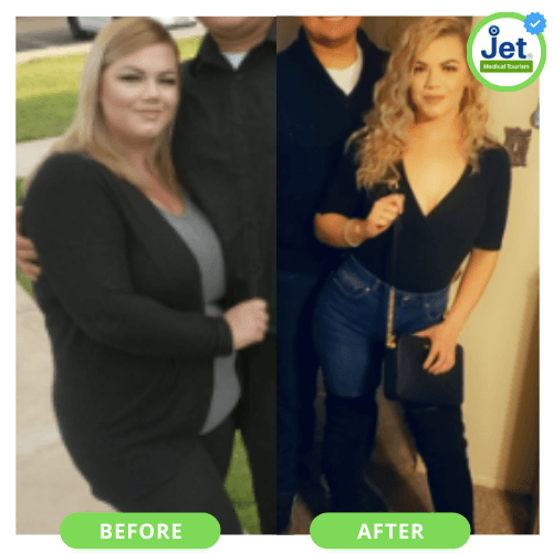 Gastric Sleeve Before and After Pictures: Best VSG Photos (2023)