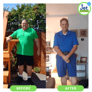 Gastric Sleeve Before and After Pictures: Best VSG Photos (2023)